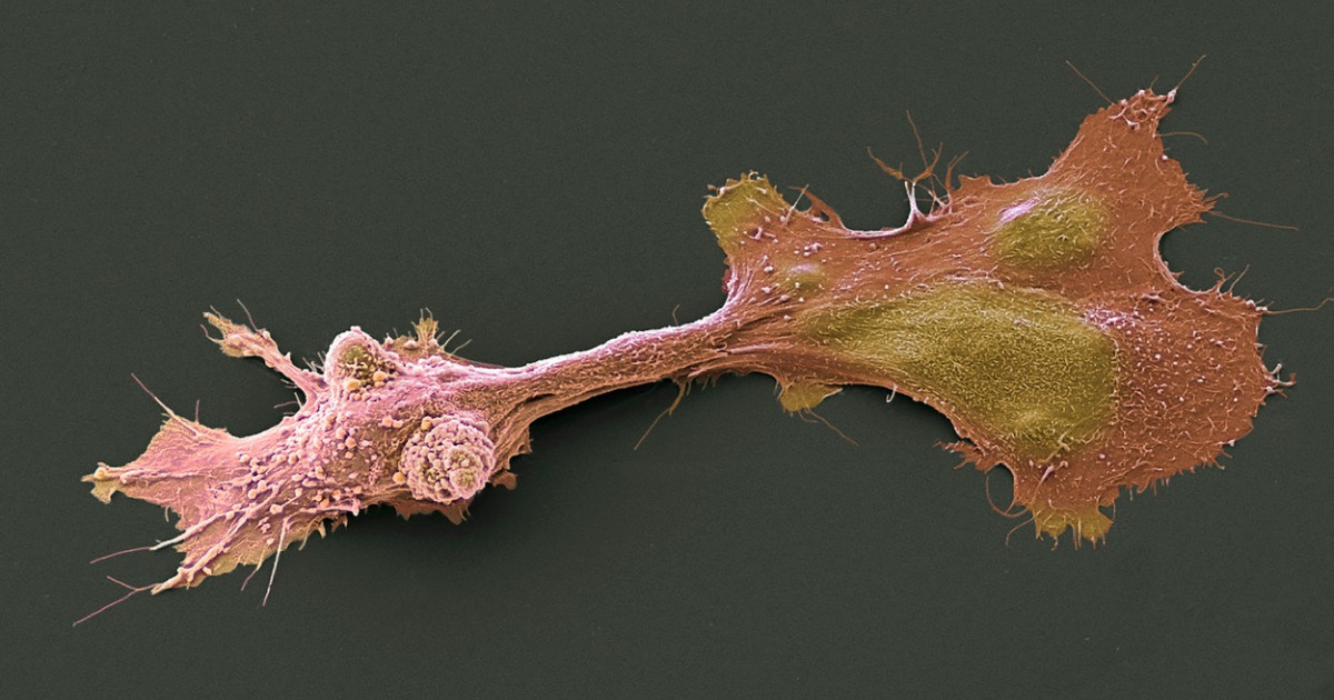Cum acționează sistemul anti-cancer din celule umane, descoperit de cercetători israelieni