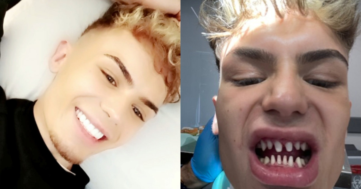 Un tânăr de 22 de ani se plânge că arată „ca un rechin” după ce s-a dus la dentist, în Turcia